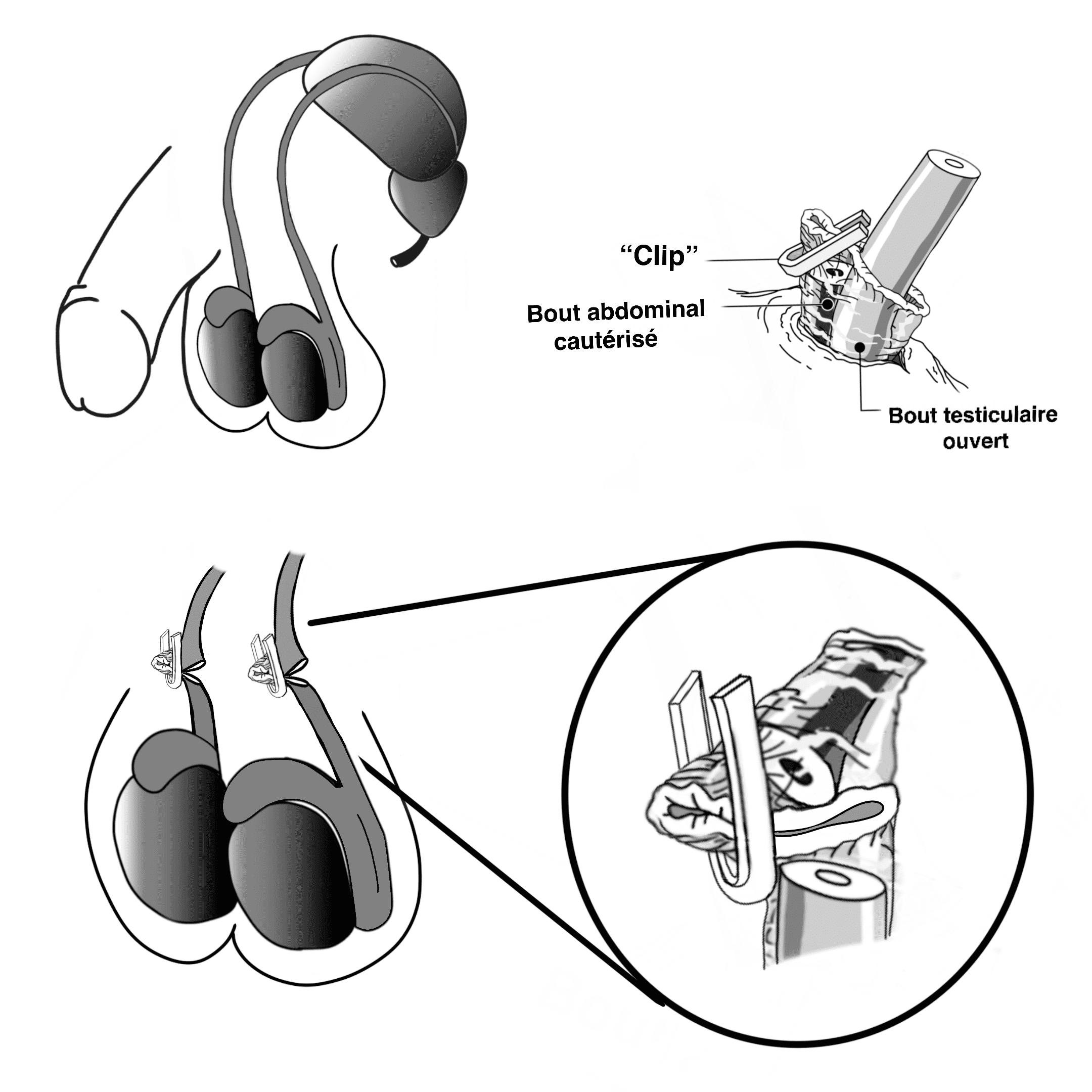 Image d"illustration du processus de vasectomie